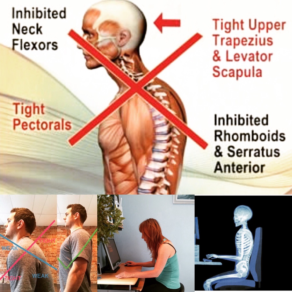 Upper cross syndrome