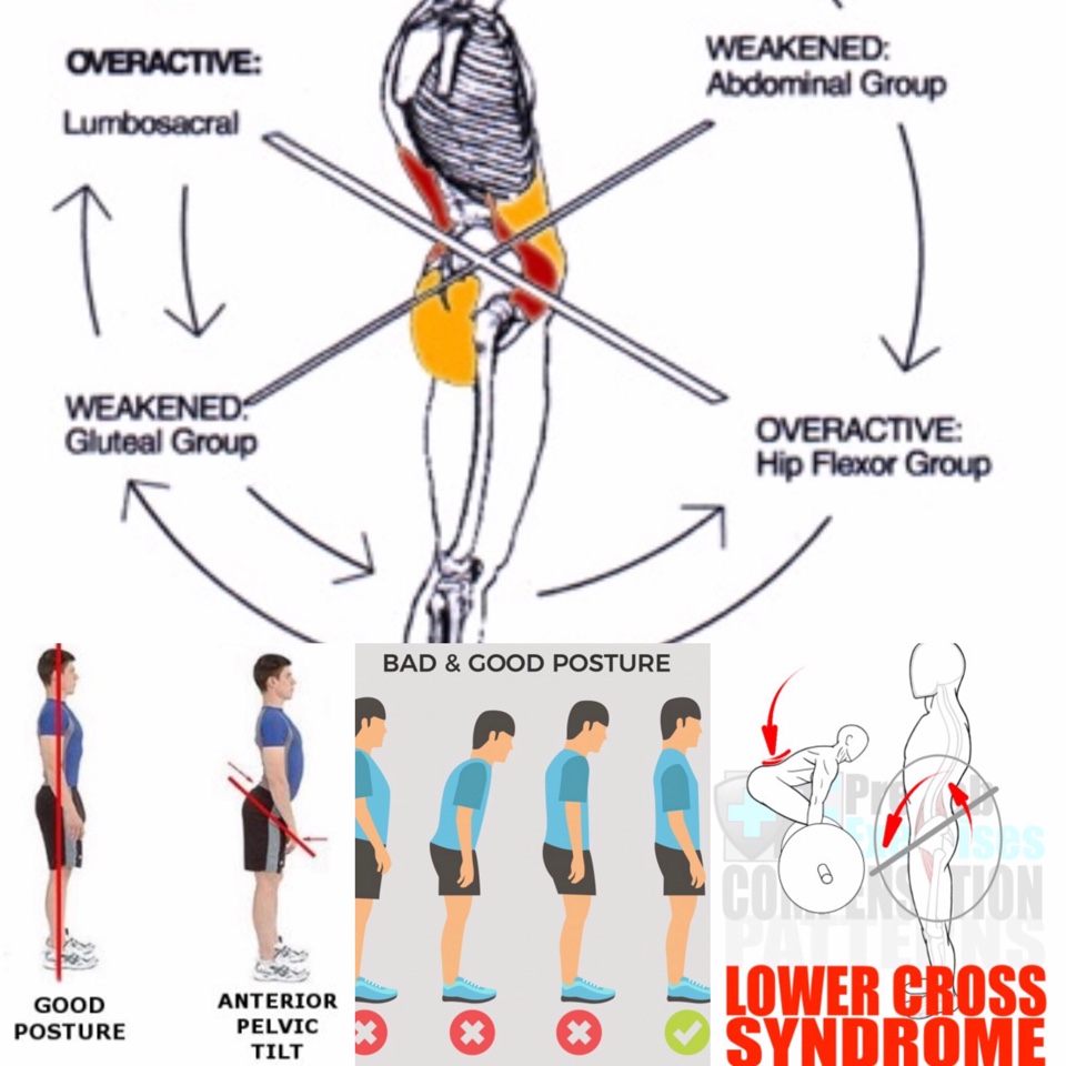 Lower Cross Syndrome