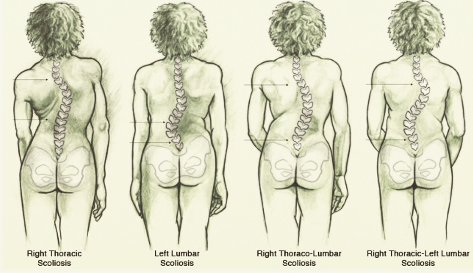 La Scoliosi