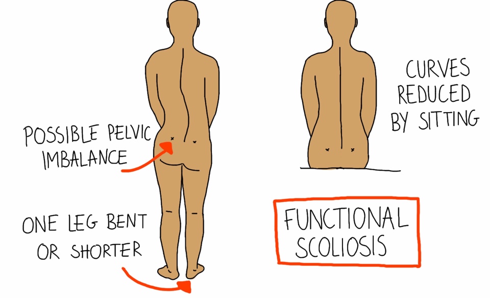 Scoliosis by Definition