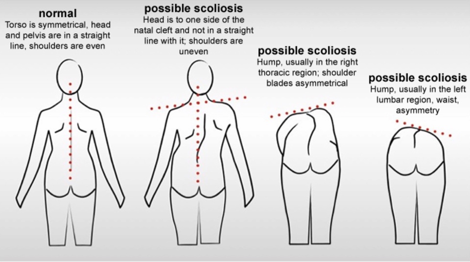 Scoliosis by Definition