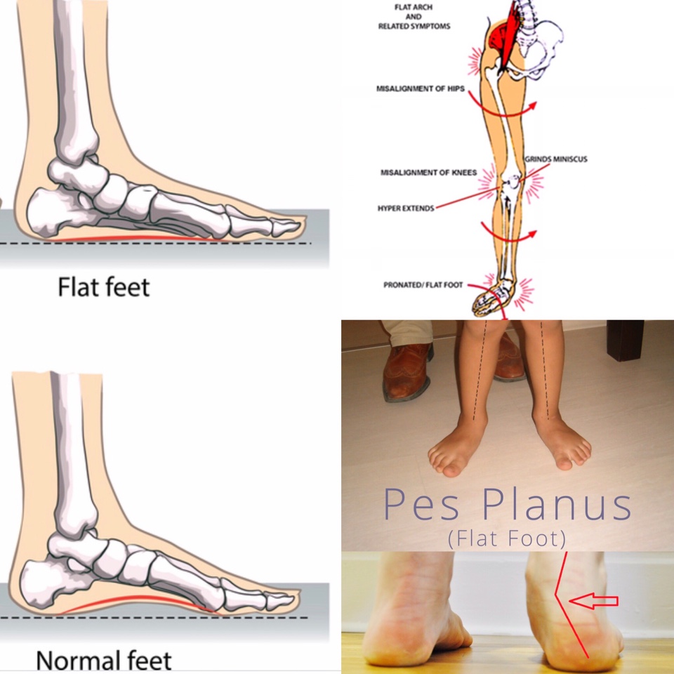 PES PLANUS (PIEDI PIATTI)