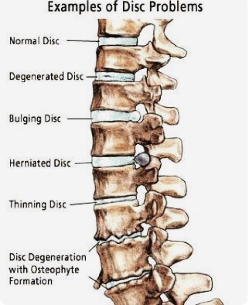 Degenerazione e ernizione del disco intervertebrale