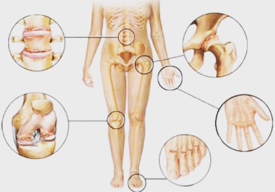 Osteoartrite