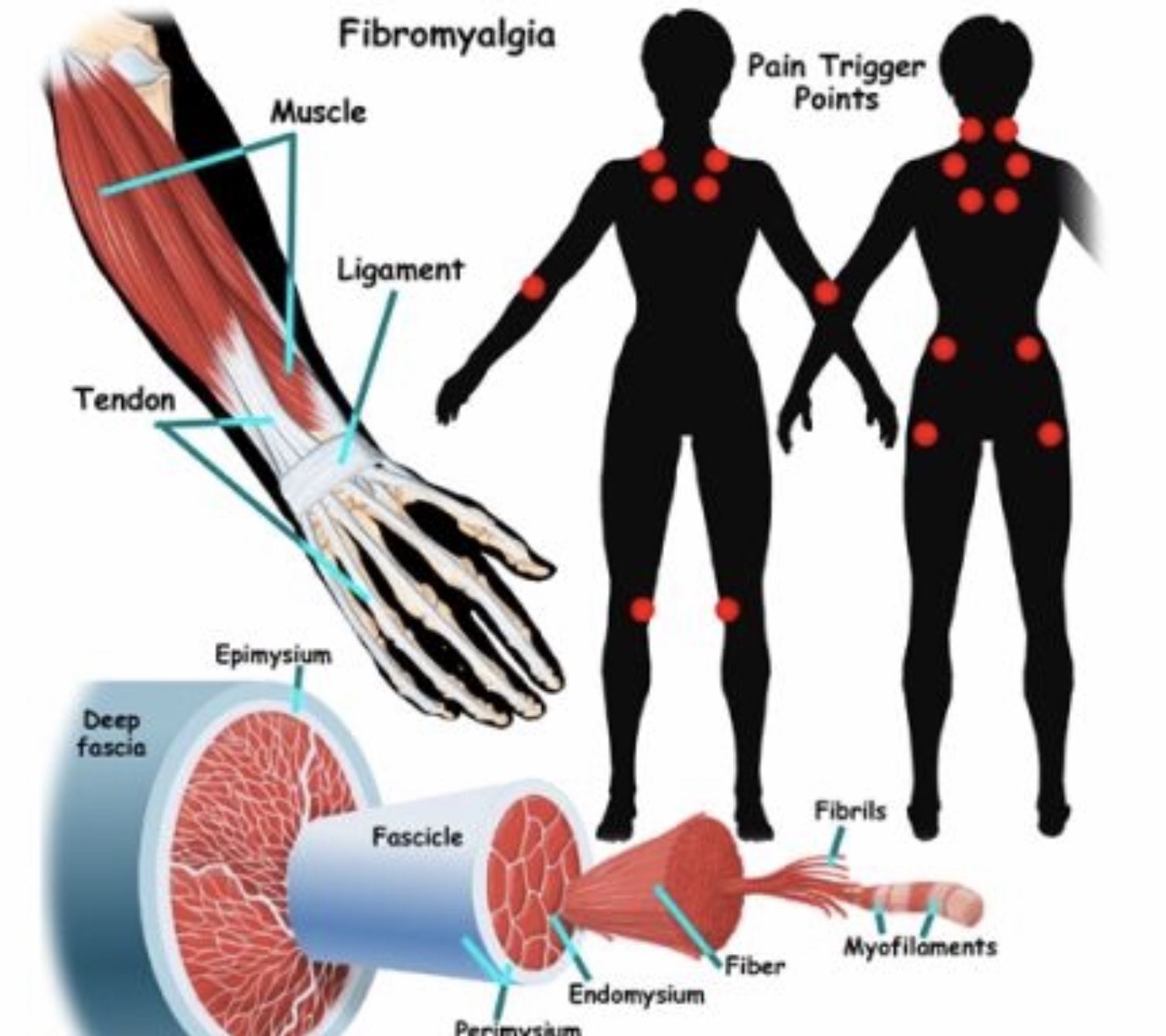 Fibromialgia