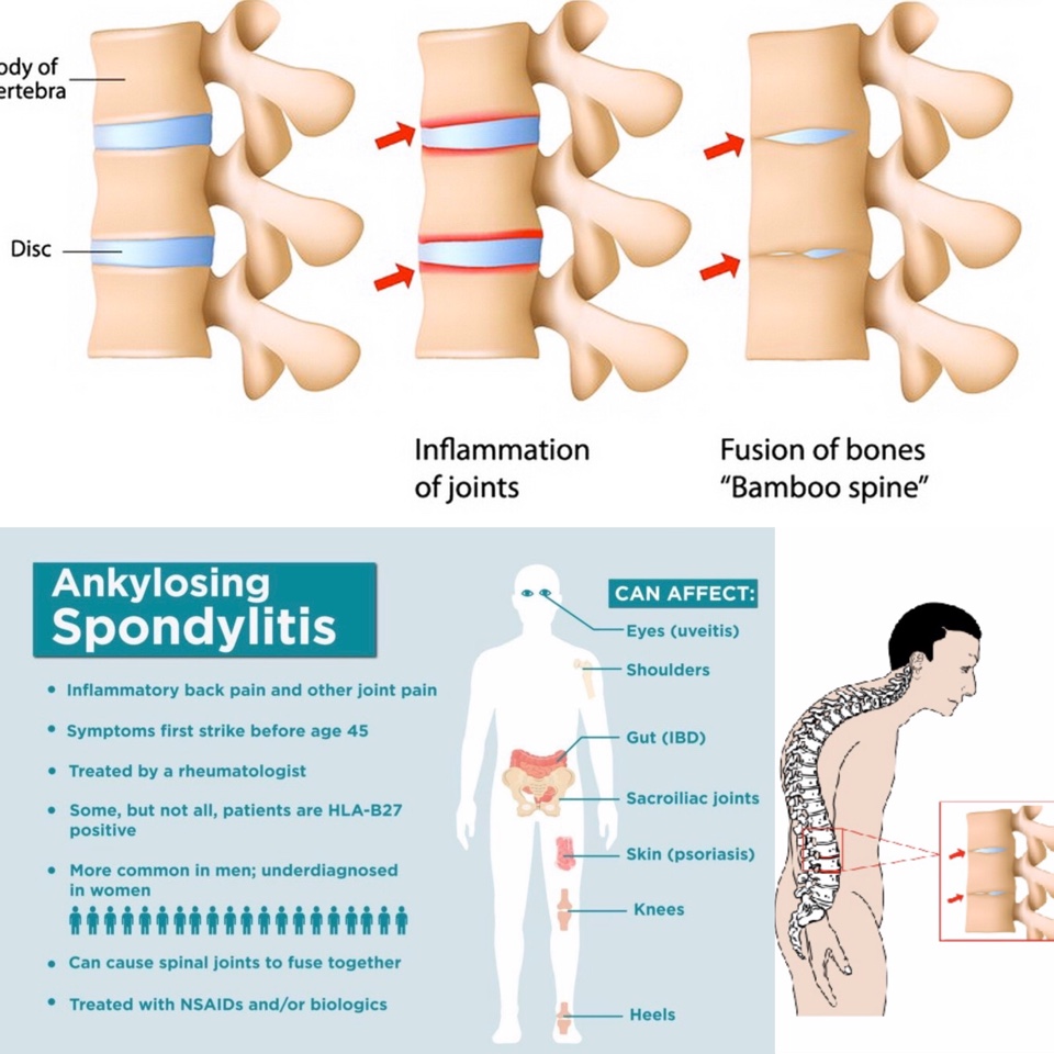 Spondilite Achilosante