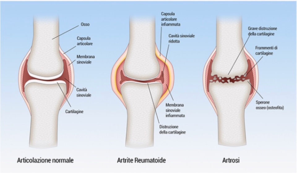 Artrite Reumatoide