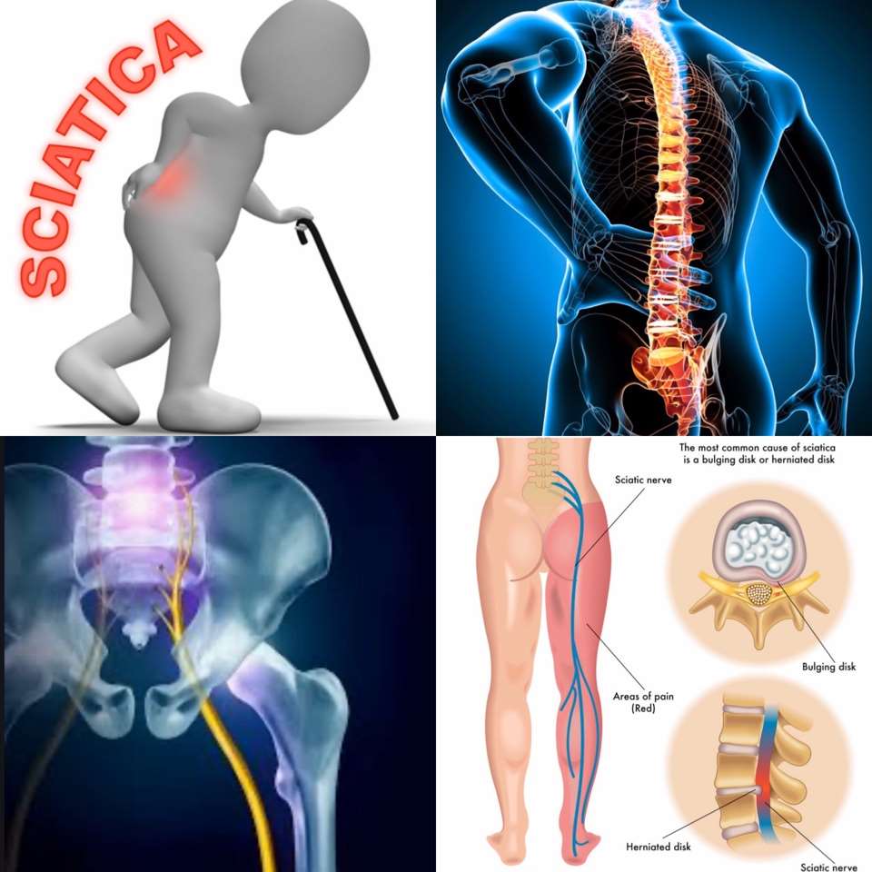 Sciatalgia