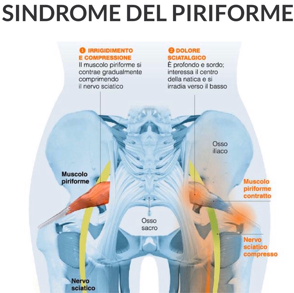 La Sindrome del Piriforme