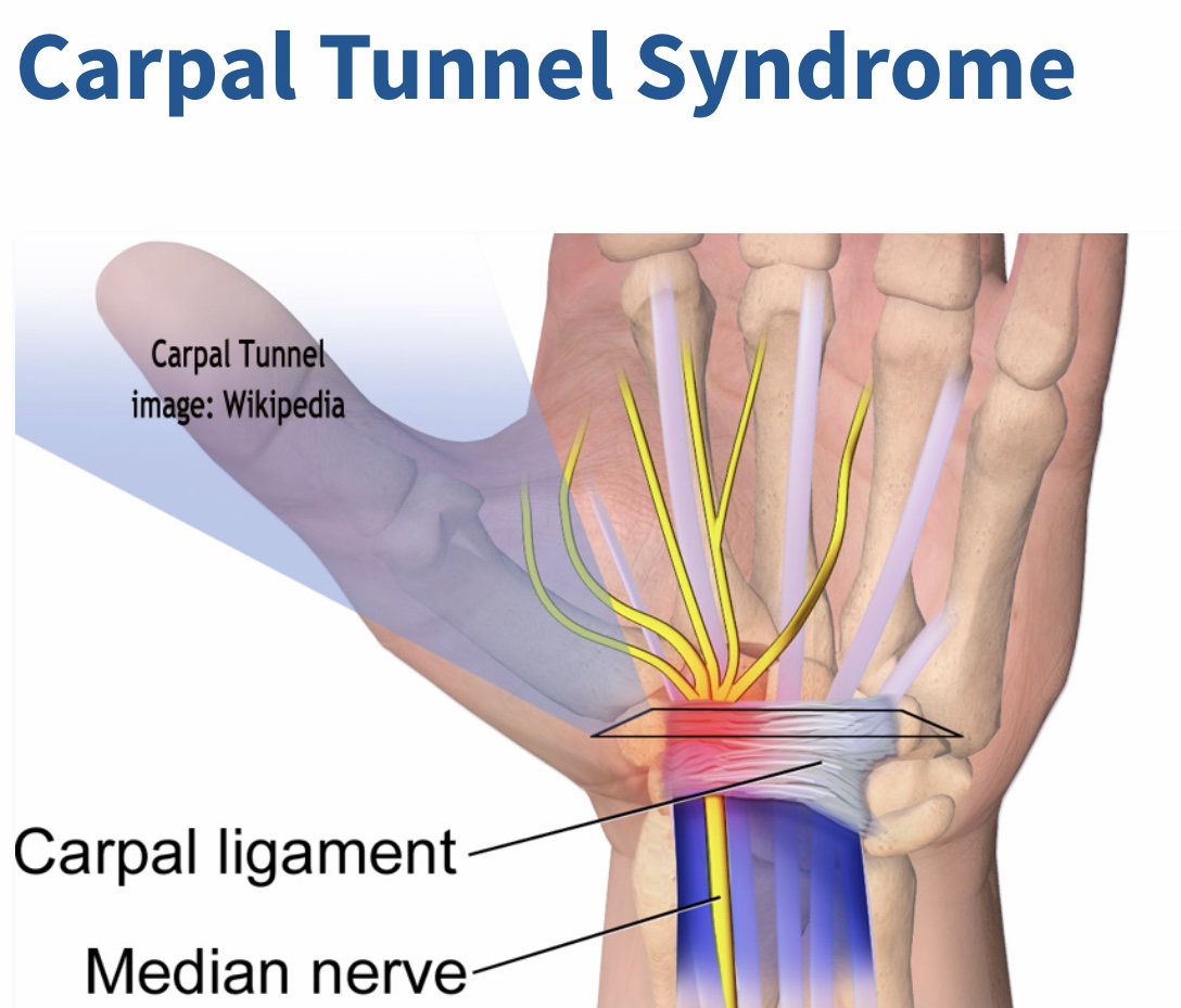 La Sindrome del Tunnel Carpale