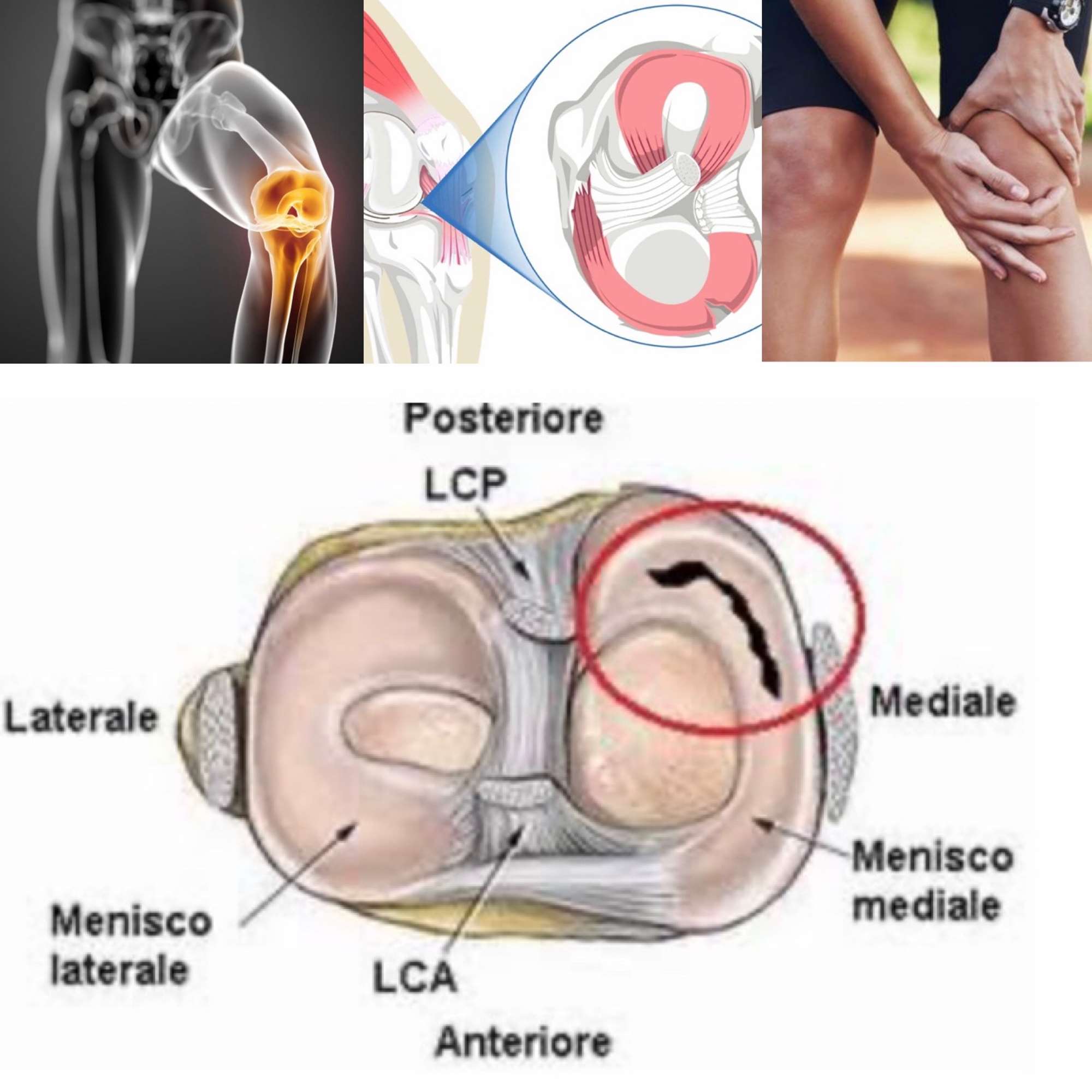 Lesione del Menisco